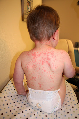 آلرژی پوستی در کودکان چگونه است؟