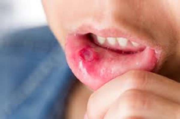 چه چیزی باعث زخم دهان می شود و چگونه آن را درمان کنیم
