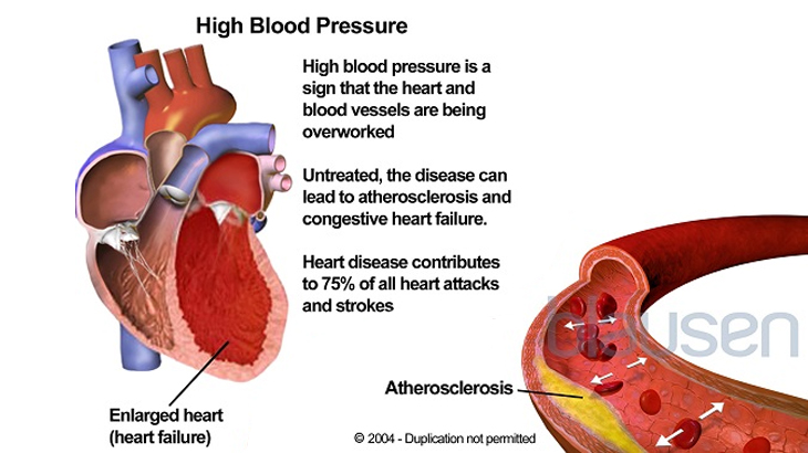 فشار خون بالا (هایپرتنشن)