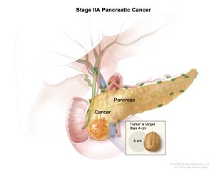 سرطان پانکراس