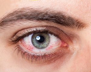 خشکی چشم به چه دلیل اتفاق می افتد؟