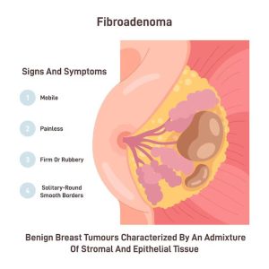 فیبروآدنوم چیست؟
